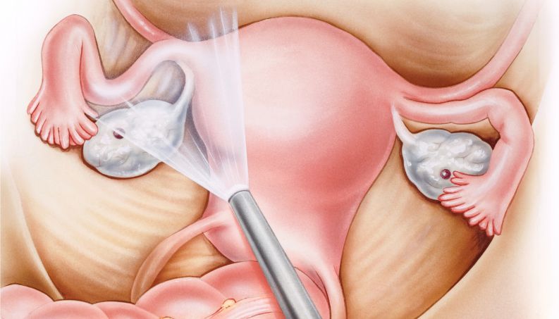 Como é a cirurgia de câncer de útero?